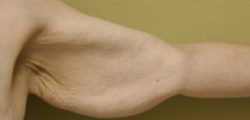 Arm Lift