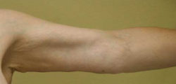 Arm Lift