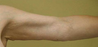 Armlift Results Tampa Bay