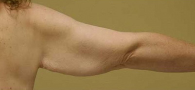 Arm Lift