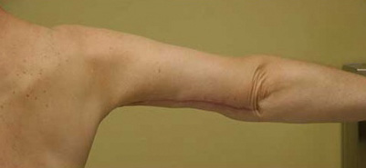 Arm Lift