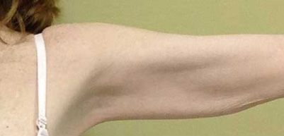 Arm Lift