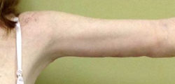 Arm Lift