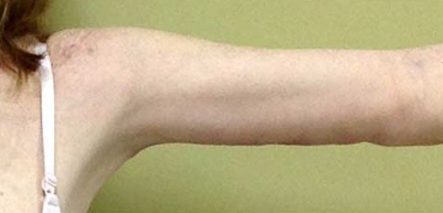 Arm Lift