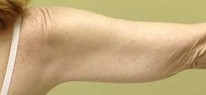 Arm Lift