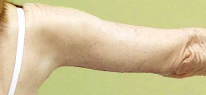 Arm Lift