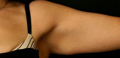 Arm Lift