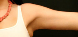 Arm Lift