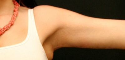 Arm Lift