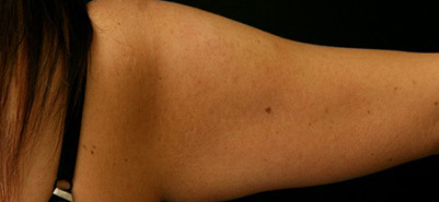 Arm Lift