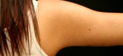 Arm Lift
