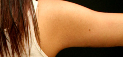 Arm Lift