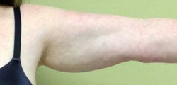 Arm Lift