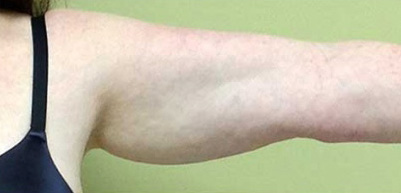 Arm Lift