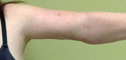 Arm Lift
