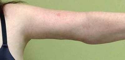 Arm Lift