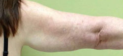 Arm Lift