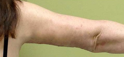 Arm Lift