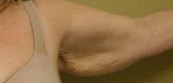 Arm Lift