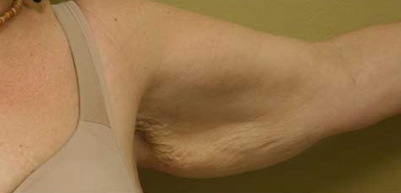 Arm Lift