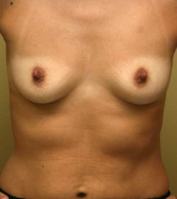 Breast Augmentation