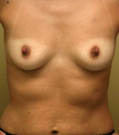 Breast Augmentation Results Tampa Bay