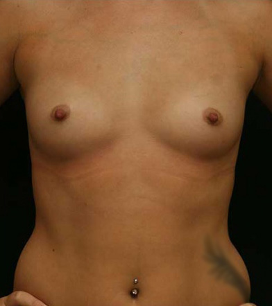 Breast Augmentation