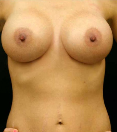 Breast Augmentation