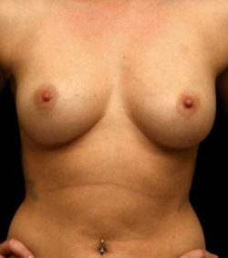 Breast Augmentation