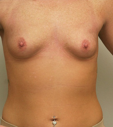 Breast Augmentation