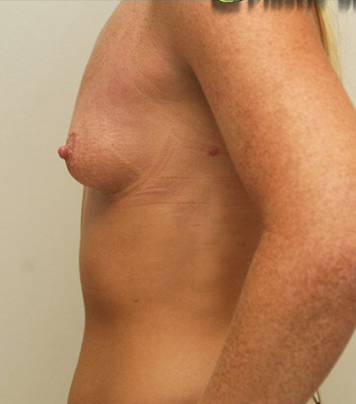 Breast Augmentation