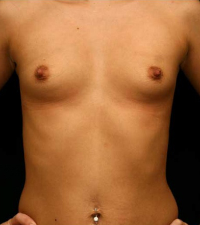 Breast Augmentation