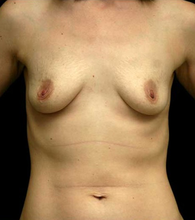 Breast Augmentation