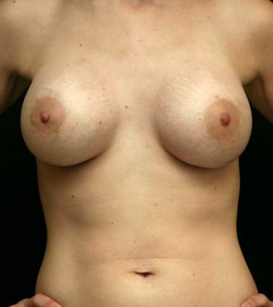 Breast Augmentation