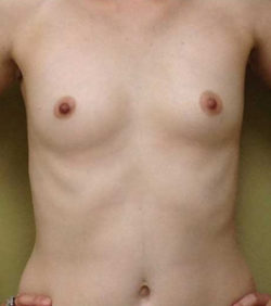 Breast Augmentation