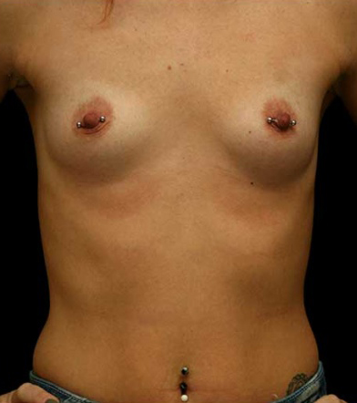 Breast Augmentation