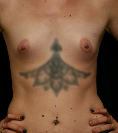 Breast Augmentation