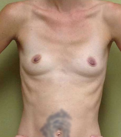 Breast Augmentation