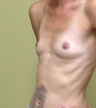 Breast Augmentation