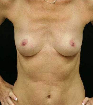 Breast Augmentation