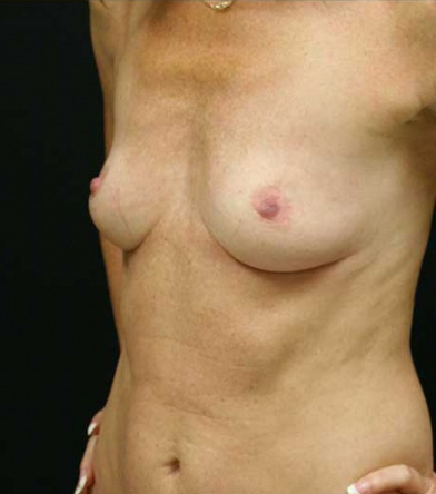 Breast Augmentation
