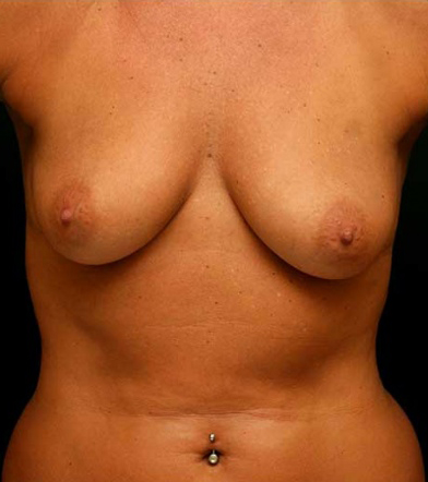 Breast Augmentation