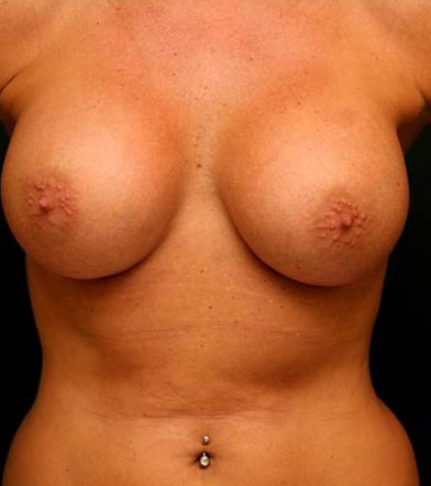 Breast Augmentation