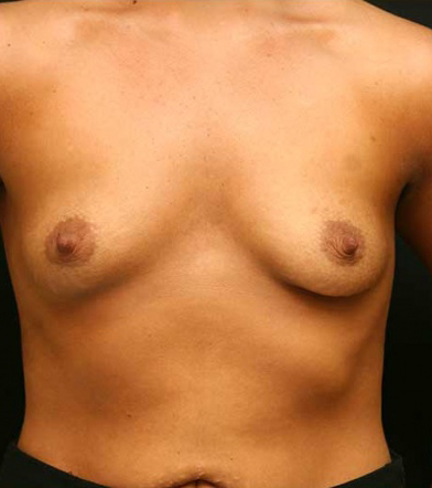 Breast Augmentation