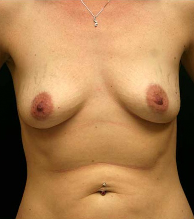 Breast Augmentation