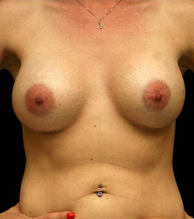 Breast Augmentation