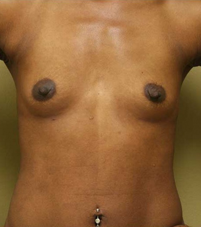 Breast Augmentation