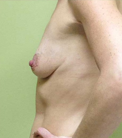 Breast Augmentation