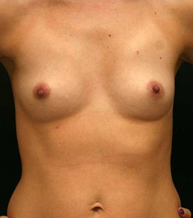 Breast Augmentation