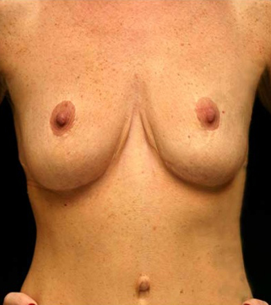 Breast Augmentation